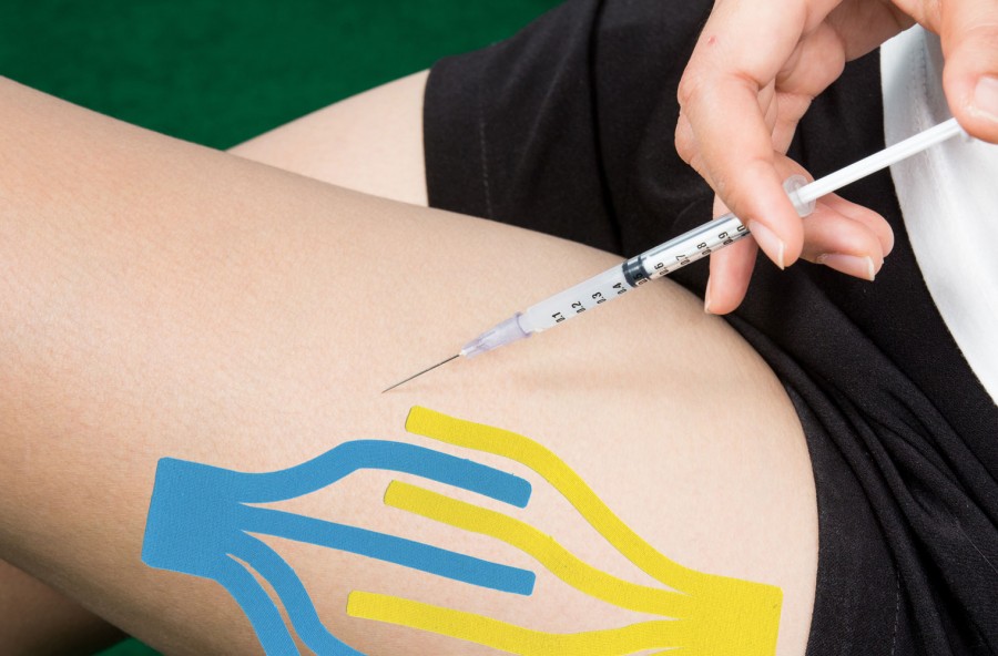 Mesotaping, la cellulite si elimina così