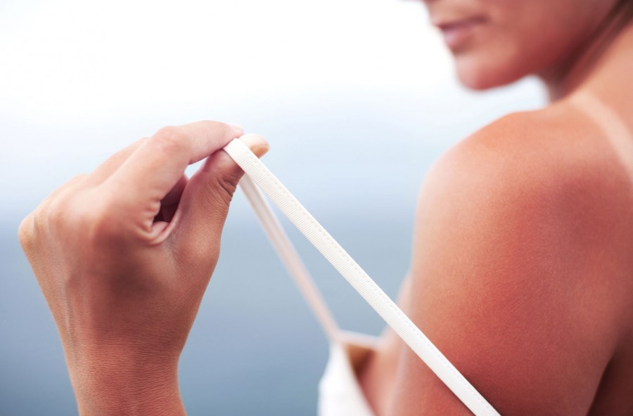 Scottature solari: rimedi semplici e rinfrescanti