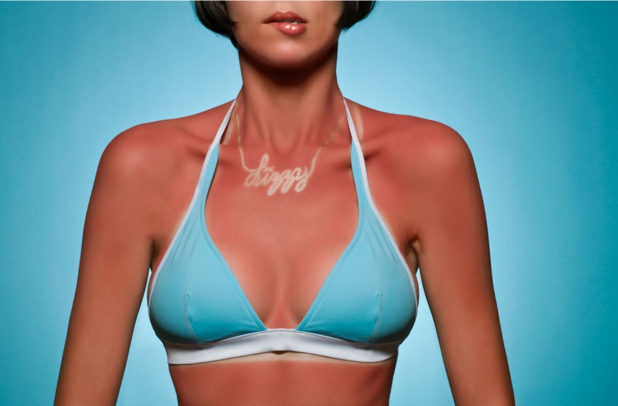 Sunburn Art: la pericolosa moda di “tatuarsi” con il sole