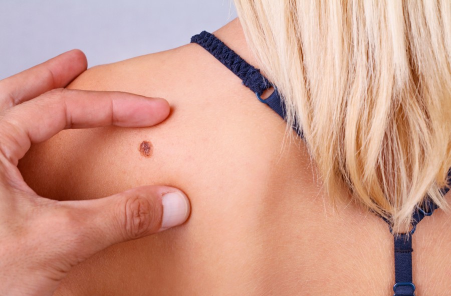 Melanomi in aumento: ecco come proteggersi