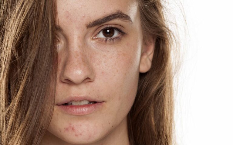 Portrait of young beautiful woman with frackles and problematic skin on white backgeound