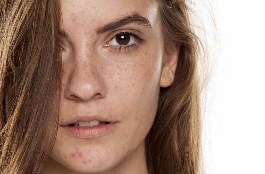 Acne: come sconfiggerla in 7 mosse