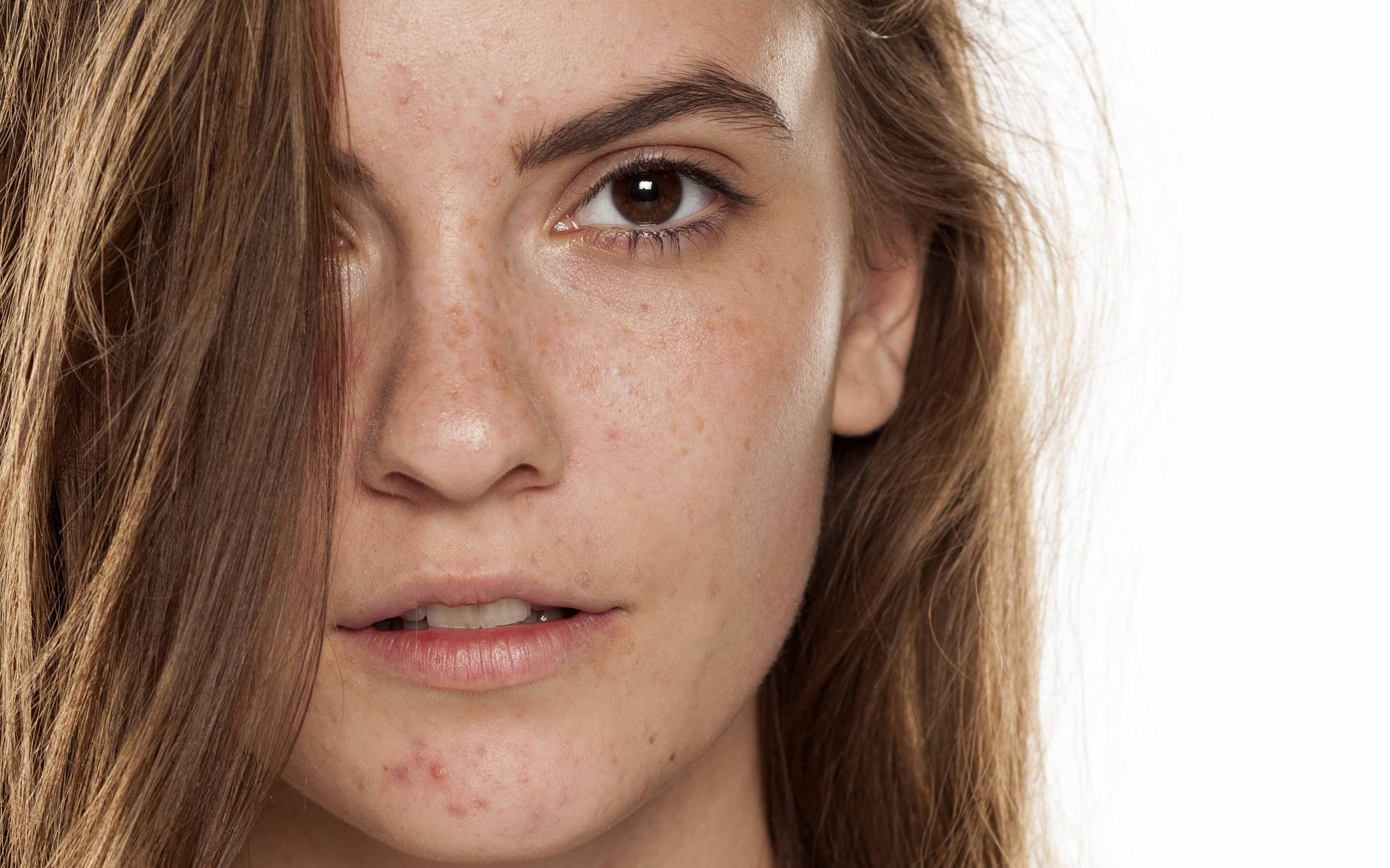 Acne. Подросток с проблемной кожей.