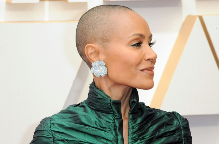 Alopecia areata: arrivano i farmaci biologici